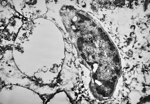 M,50y. | Pneumocystis carinii - lung M,50y. | Pneumocystis carinii - lung